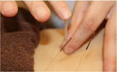 鍼治療で自律神経を整えて頭痛を改善